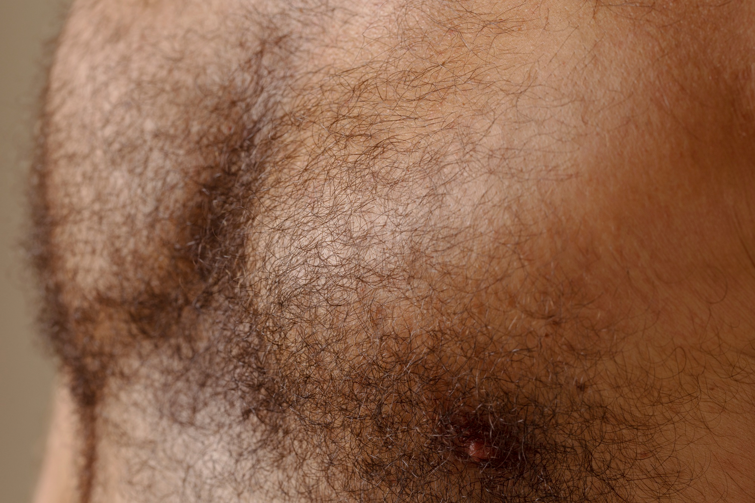 excess dark, coarse hair on the face or body